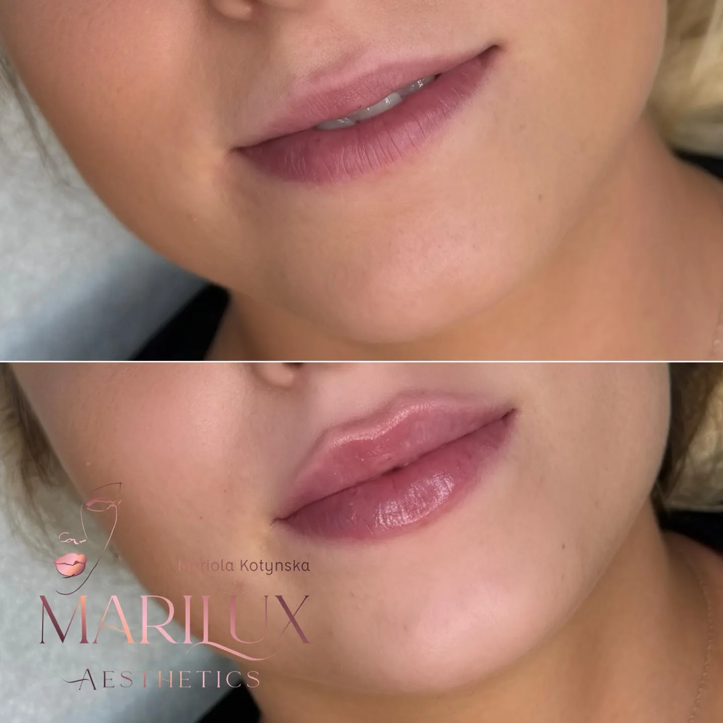 Lip filler result 2 — plump natural lips